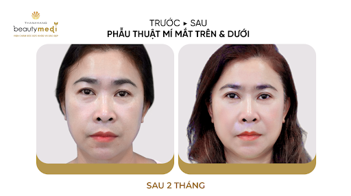 2 mắt không đều