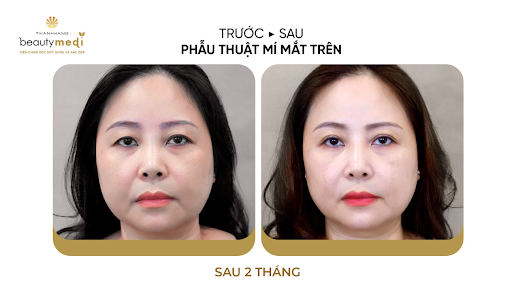 2 mắt không đều