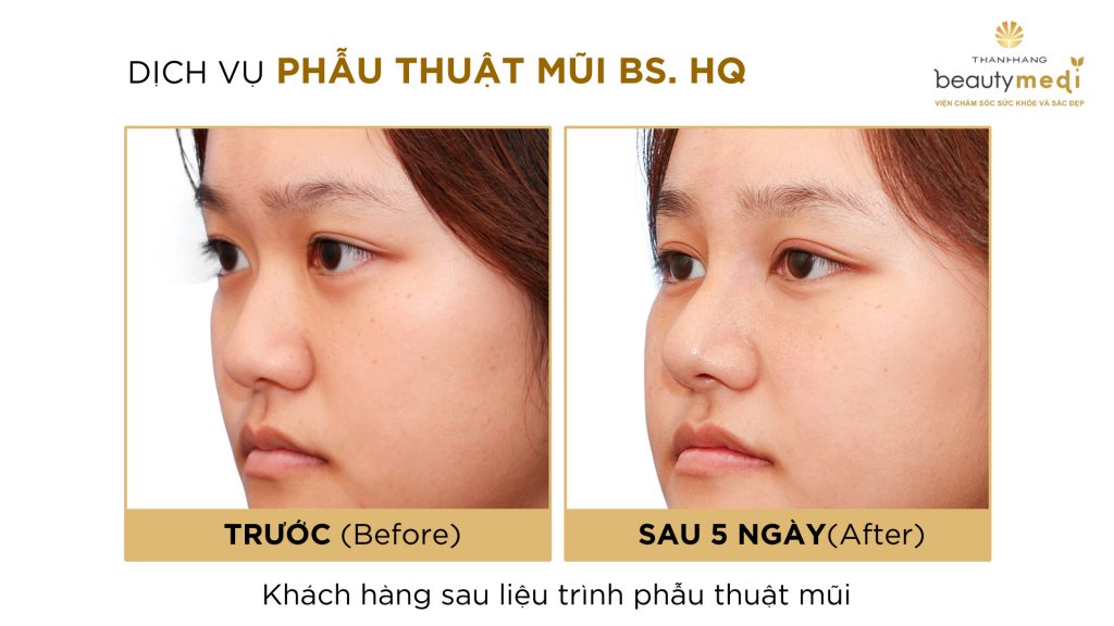 dịch vụ phẫu thuật mũi tại Beauty Medi