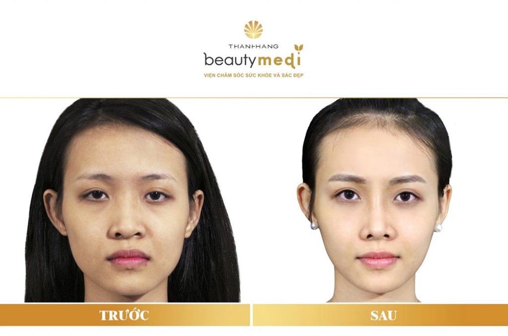 Trương Mỹ Nhân phẫu thuật nâng và thu hẹp cánh mũi tại Thanh Hằng Beauty Medi 