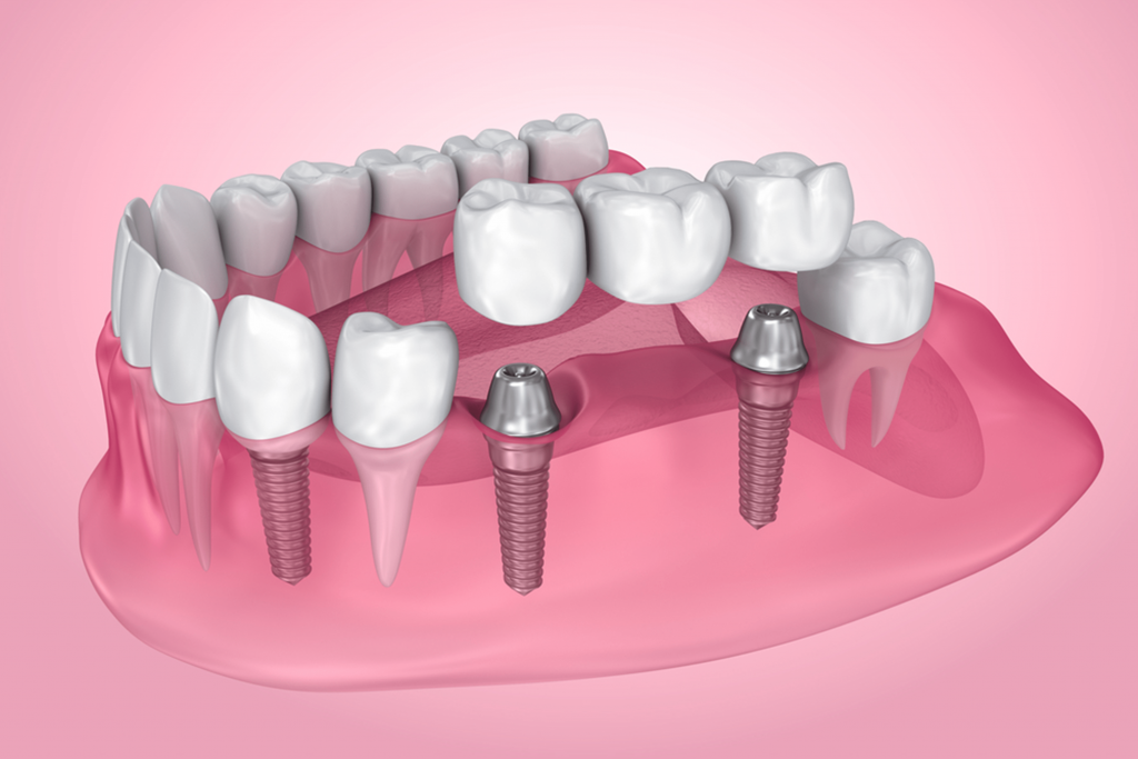 Trồng răng Implant sẽ giúp bảo tồn được xương hàm