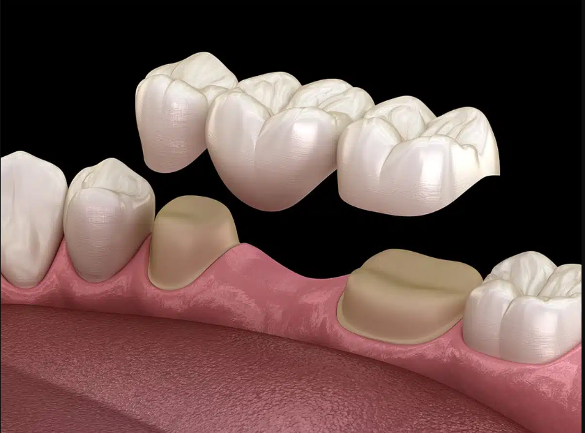 Cầu răng có màu sắc tự nhiên tương tự như màu răng thật