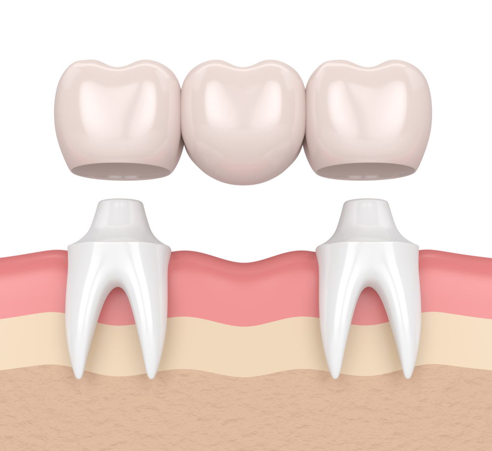 Phương pháp làm cầu răng được chỉ định cho các trường hợp bị mất 1 hoặc một vài chiếc răng