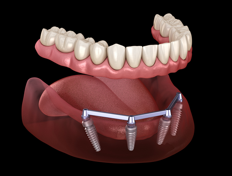 Phương pháp trồng răng Implant thường được ưu tiên lựa chọn bởi sở hữu nhiều ưu điểm nổi trội