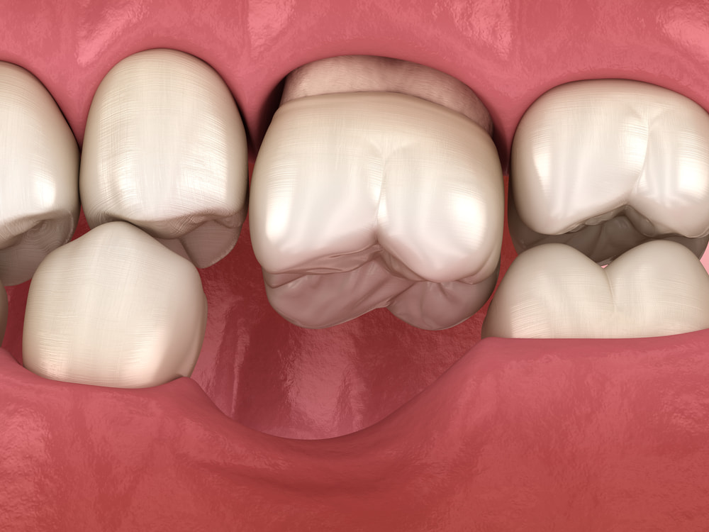 Tình trạng mất răng lâu năm gây ra nhiều vấn đề đáng lo ngại 