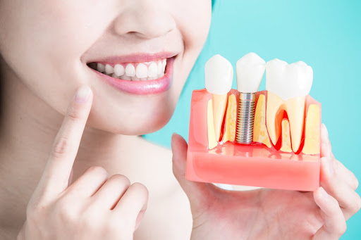 sau khi trồng răng implant nên ăn gì