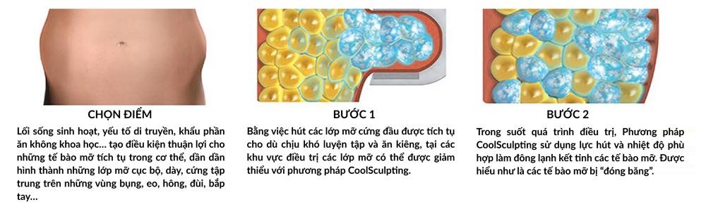 quy trình coolsculpting