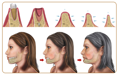 Cấy ghép implant 