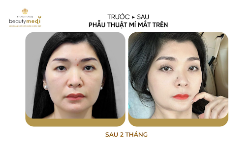 2 mắt không đều