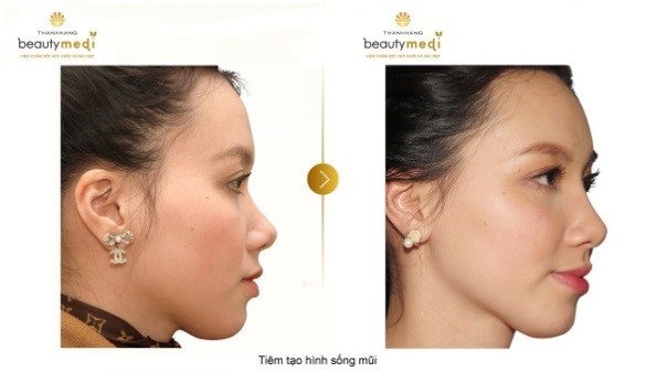 Hình ảnh khách hàng trước và sau khi sử dụng dịch vụ tiêm tạo hình mũi