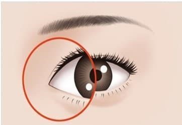 Quy trình phẫu thuật mở rộng góc mắt