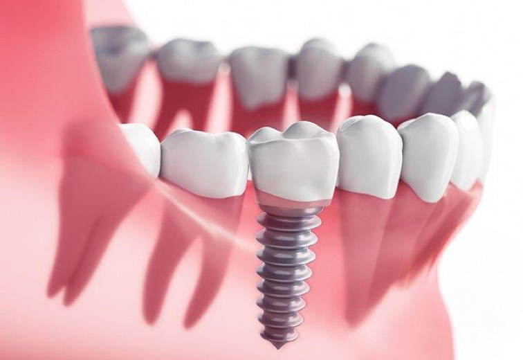 Trồng và cấy ghép implant 