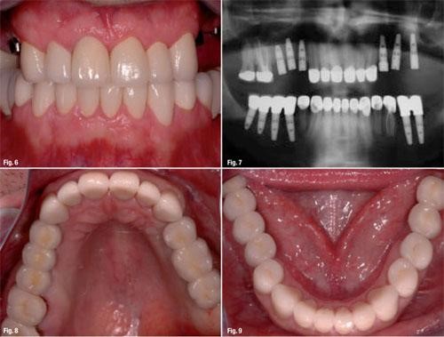 Trồng và cấy ghép implant