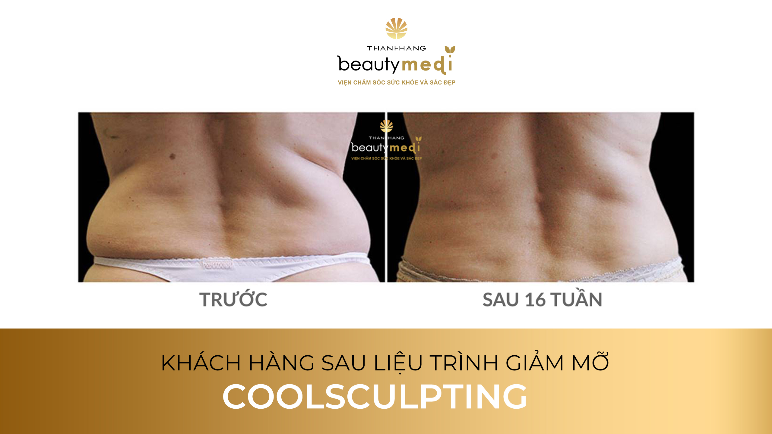 Khách hàng sau liệu trình coolsculpting