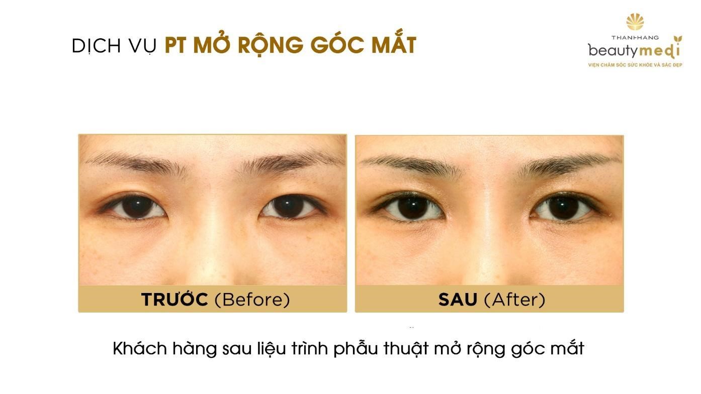 Mở rộng góc mắt