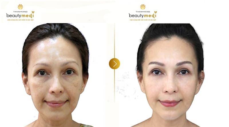 nâng cơ mặt không cần phẫu thuật