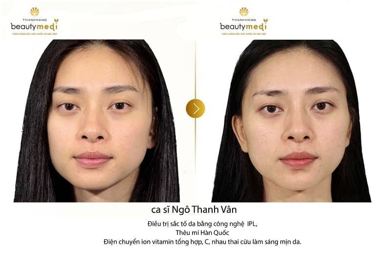 Phun thêu mí Hàn Quốc - mắt có hồn