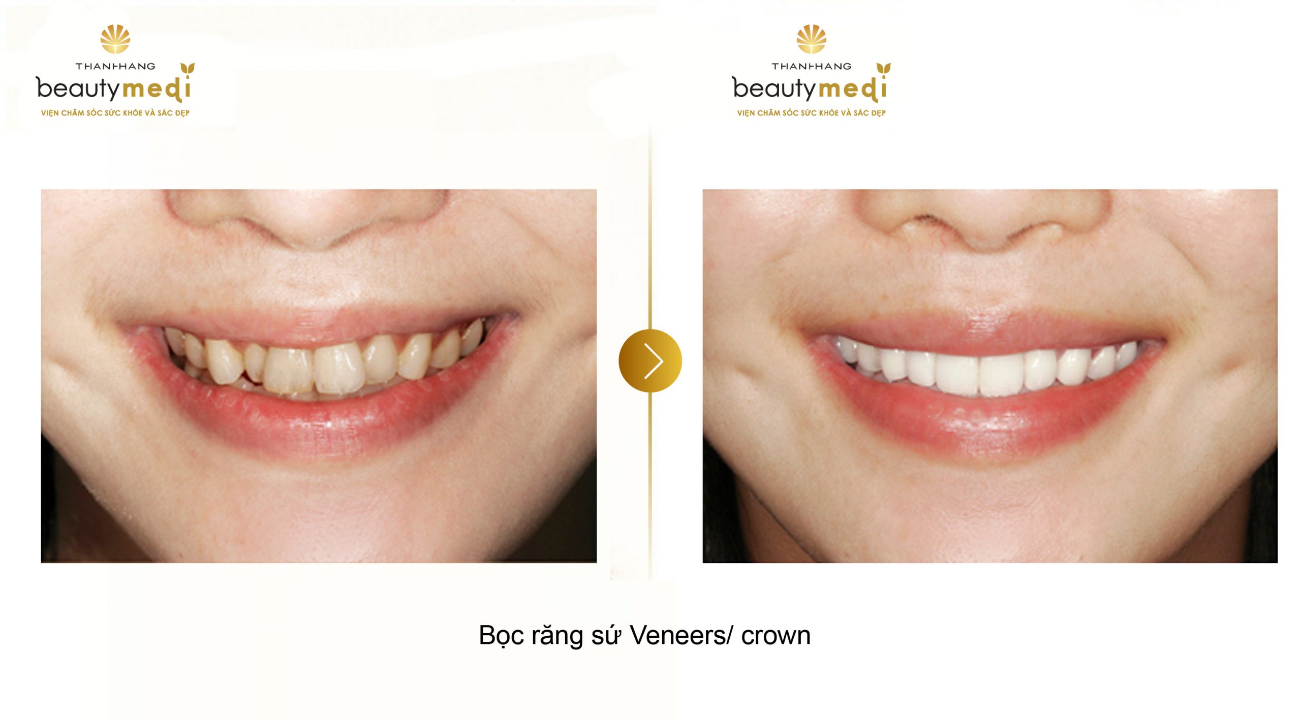 Răng trắng sáng và đều sau khi được bọc răng sứ Veneer/ Crowns