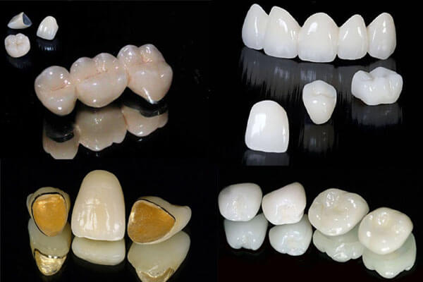 Bọc răng sứ thẩm mỹ có 2 loại: răng sứ kim loại và không kim loại