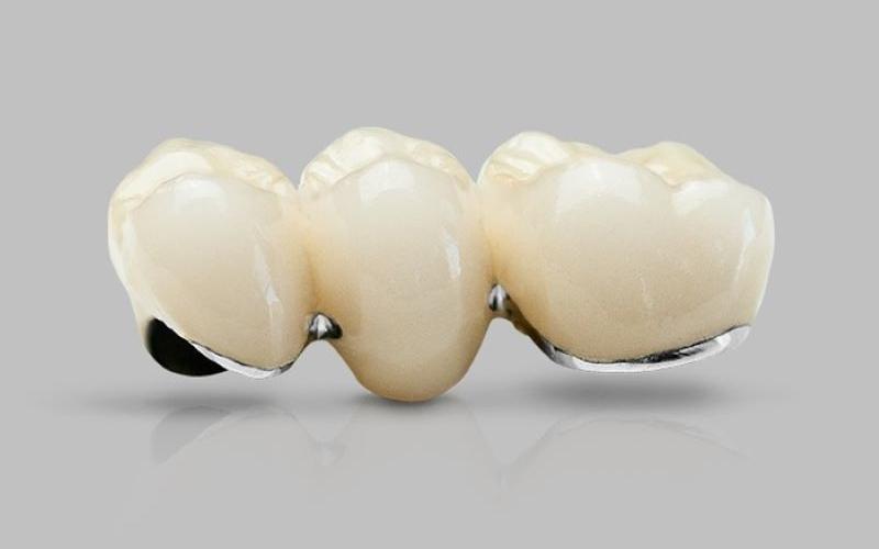 Răng sứ kim loại cũng được sử dụng phổ biến