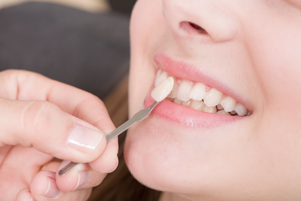Ngoài răng sứ để bọc răng sứ thẩm mỹ, mặt dán sứ cũng được nhiều người ưa chuộng