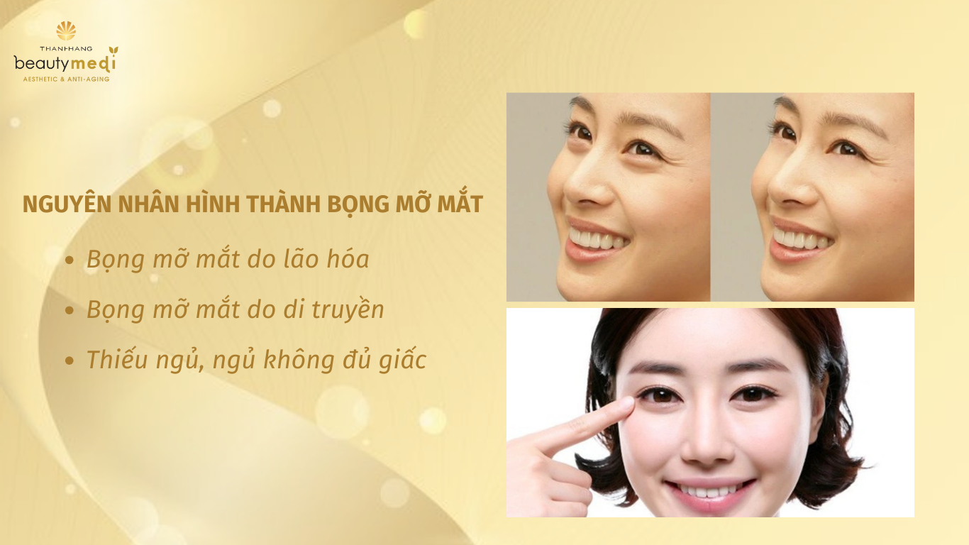 Nguyên nhân hình thành bọng mỡ mắt