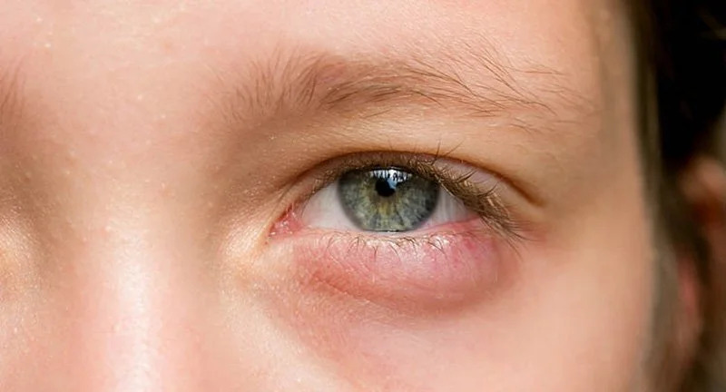 Khoảng 2-5 tuần sau khi thực hiện phẫu thuật cắt bọng mắt dưới, mắt bạn sẽ trở nên ổn định