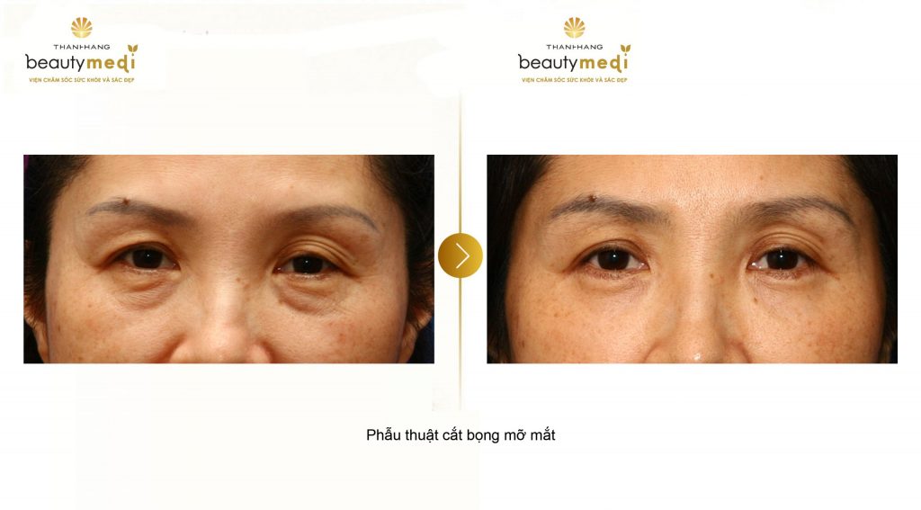 Hình ảnh thực tế của khách hàng khi sử dụng dịch vụ lấy mỡ bọng mắt tại Thanh Hằng Beauty Medi