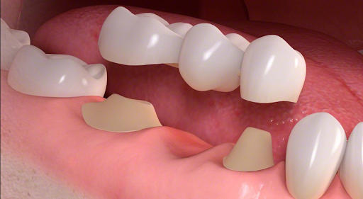 Phương pháp phục hình răng được nhiều khách hàng ưu tiên lựa chọn