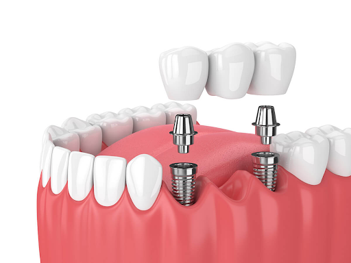 Phương pháp trồng cầu răng sứ sở hữu đồng thời nhiều ưu điểm và hạn chế