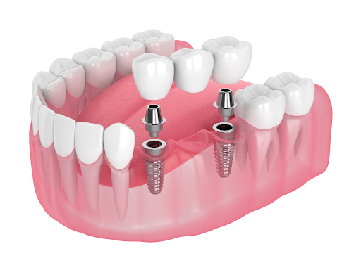 Loại cầu răng sứ được trồng trên trụ Implant