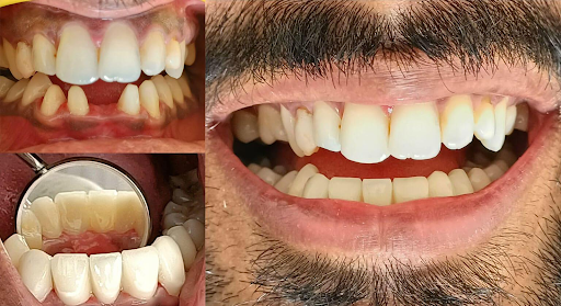 Trồng cầu răng sứ cho trường hợp bị mất răng