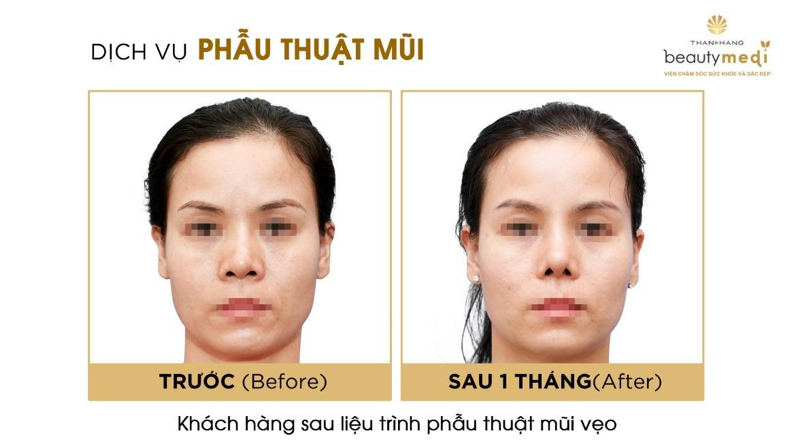 Hình ảnh khách hàng thực hiện chỉnh mũi lệch thành công tại Thanh Hằng Beauty Medi