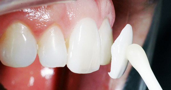 Câu hỏi “Có nên dán răng sứ hay không?” sẽ được giải đáp ở bài viết dưới đây