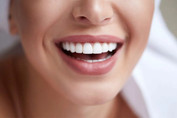 Dán răng sứ Veneer có nhiều ưu điểm vượt trội