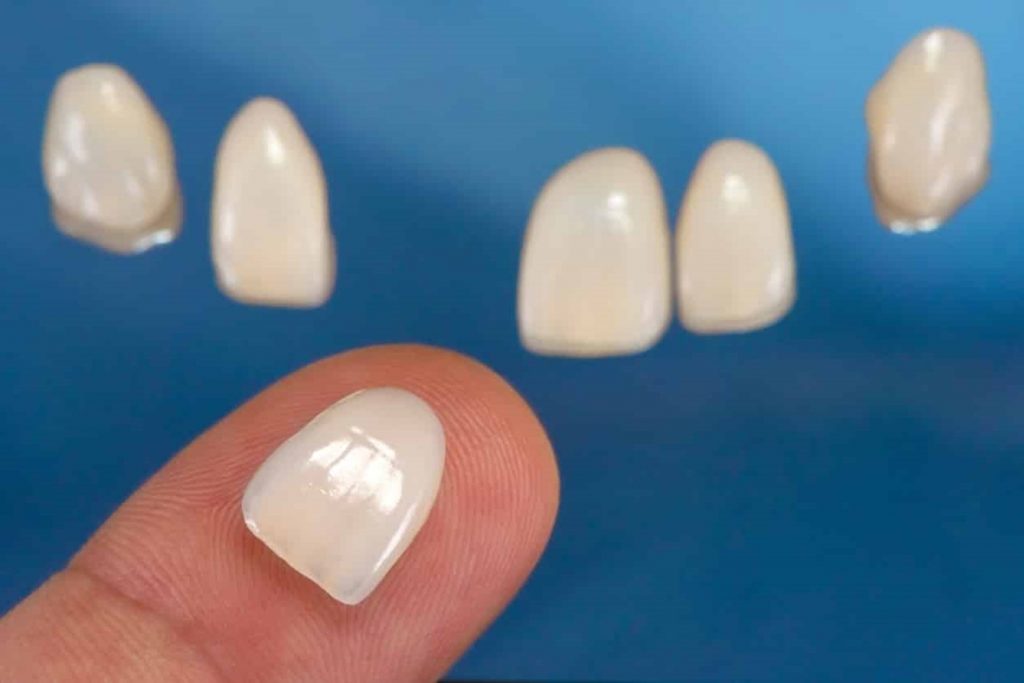 Một số khuyết điểm của dán răng sứ Veneer