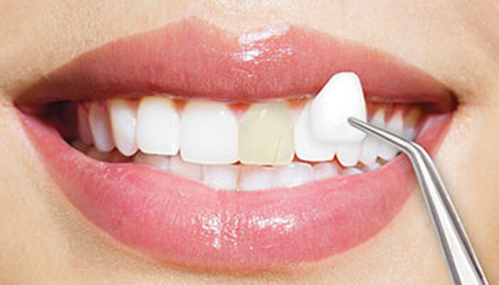 Các bạn cần đặc biệt chú ý quá trình chăm sóc sau khi dán răng sứ Veneer