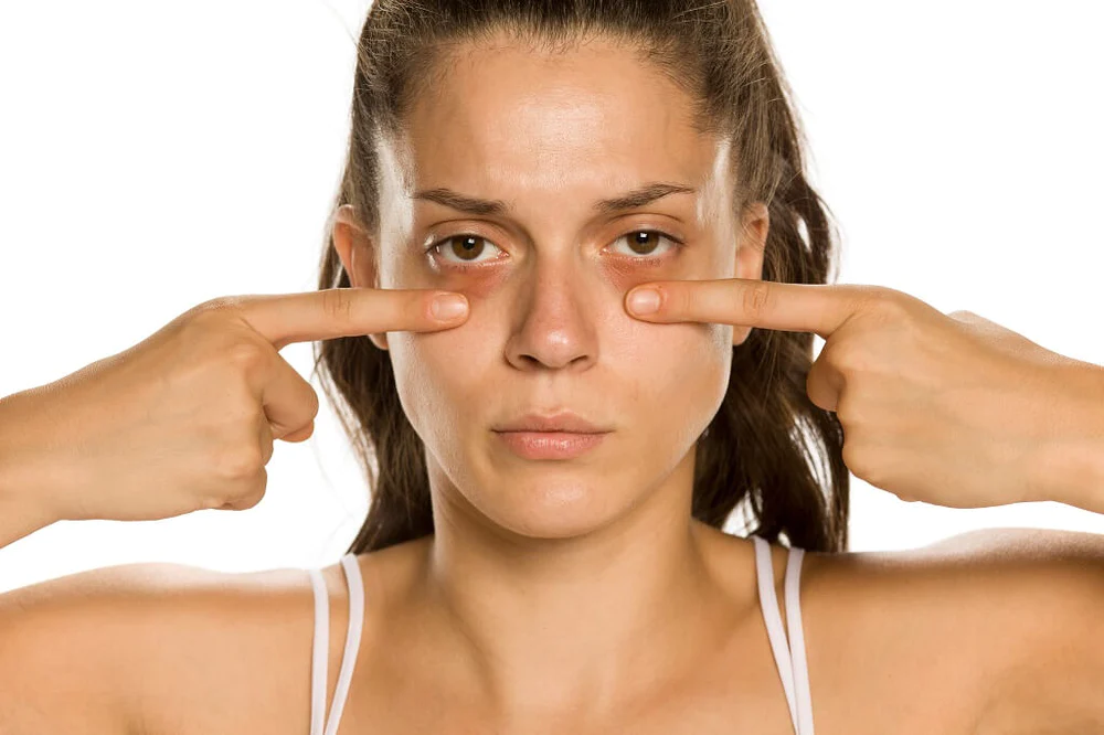 Mỡ mắt và quầng mắt thâm do thiếu ngủ 