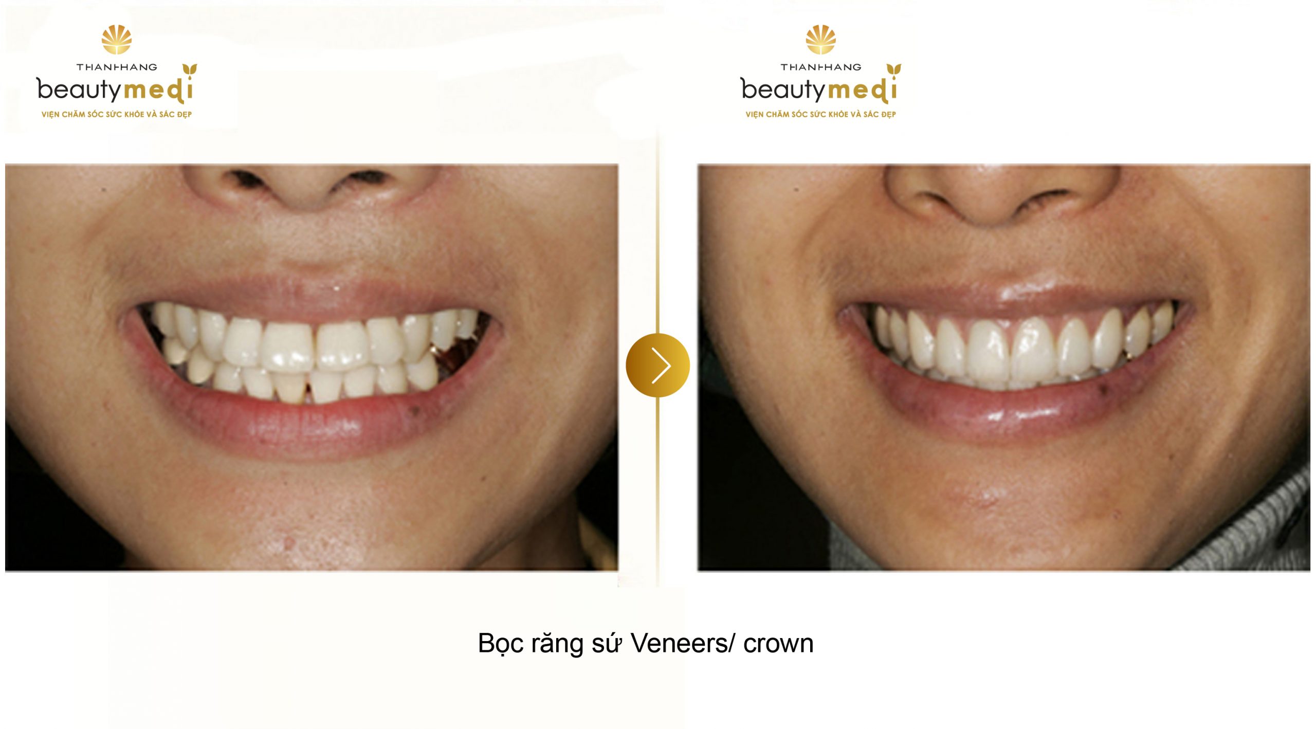 Hình ảnh thực tế của khách hàng khi sử dụng dịch vụ dán sứ Veneer tại Thanh Hằng Beauty Medi