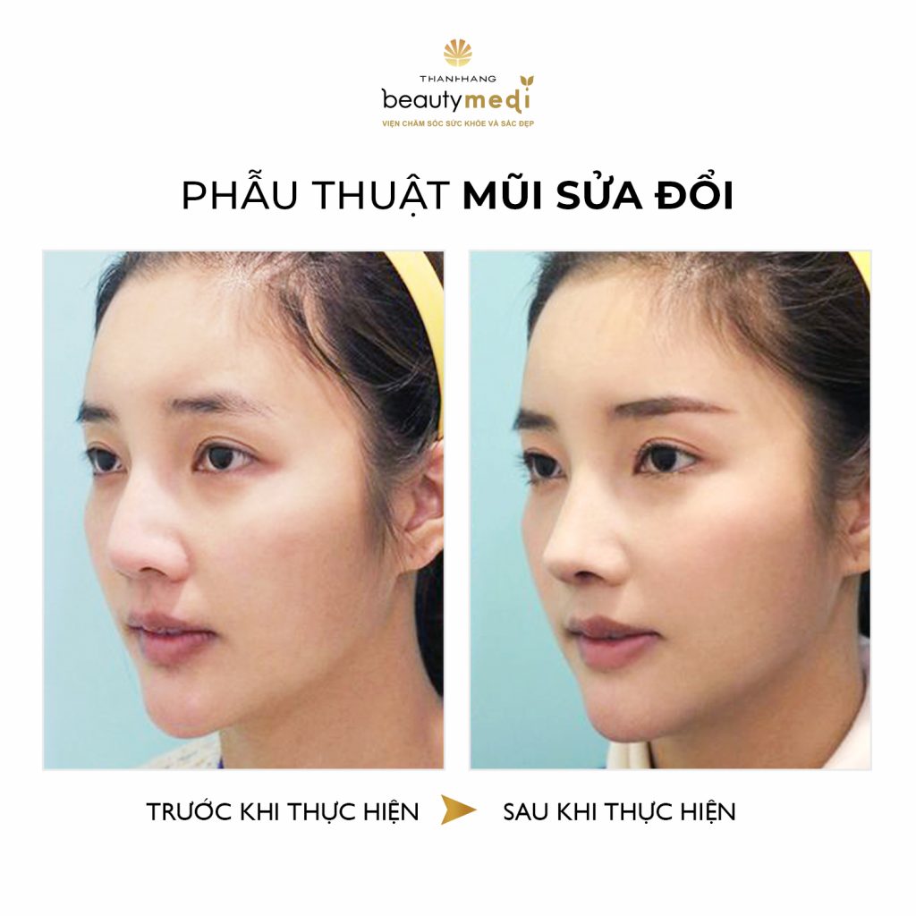 Hình ảnh khách hàng phẫu thuật mũi thành công tại Thanh Hằng Beauty Medi