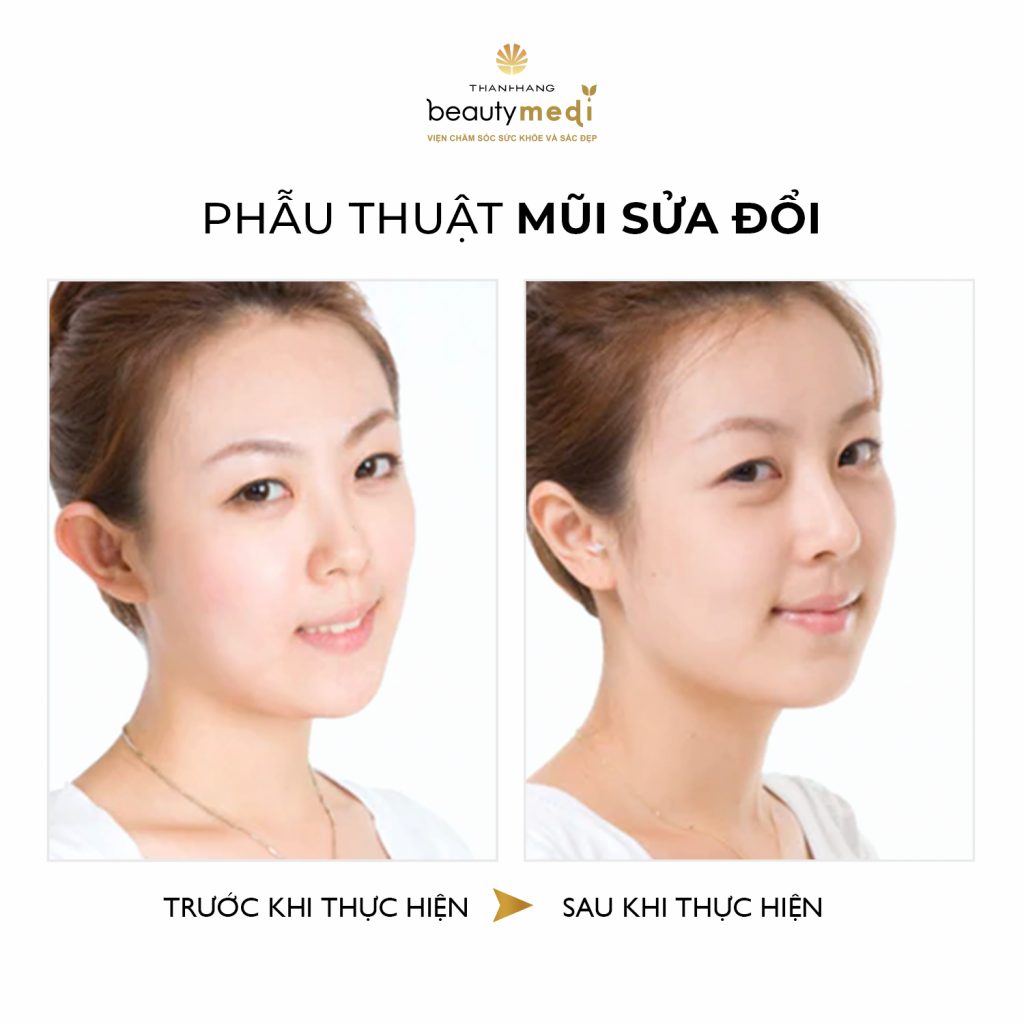 Hình ảnh khách hàng phẫu thuật mũi thành công tại Thanh Hằng Beauty Medi