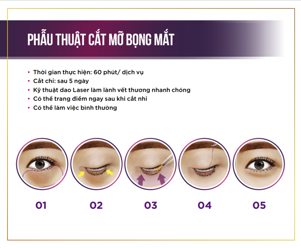 Quy trình cắt mỡ bọng mắt tại Beauty Medi