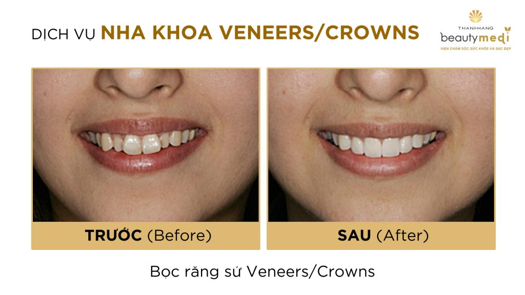 dán răng sứ veneer 