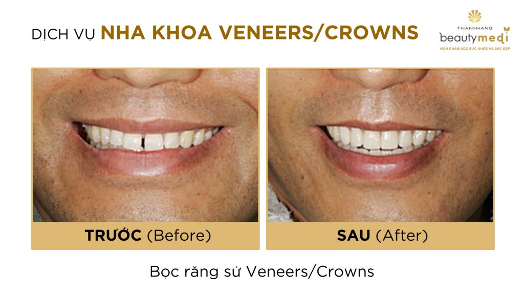 dán răng sứ veneer 