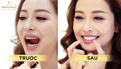 Hình ảnh trước và sau khi bọc răng sứ của khách hàng tại Thanh Hằng Beauty Medi