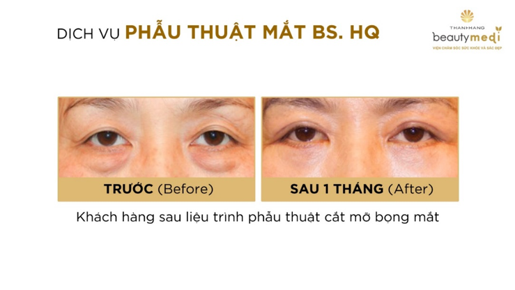 phẫu thuật mắt 2 mí 