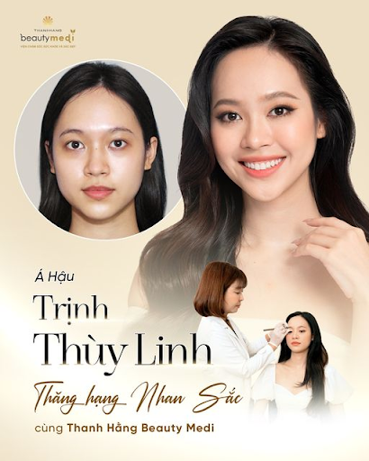 Á hậu Trình Thùy linh phẫu thuật mắt 2 mí