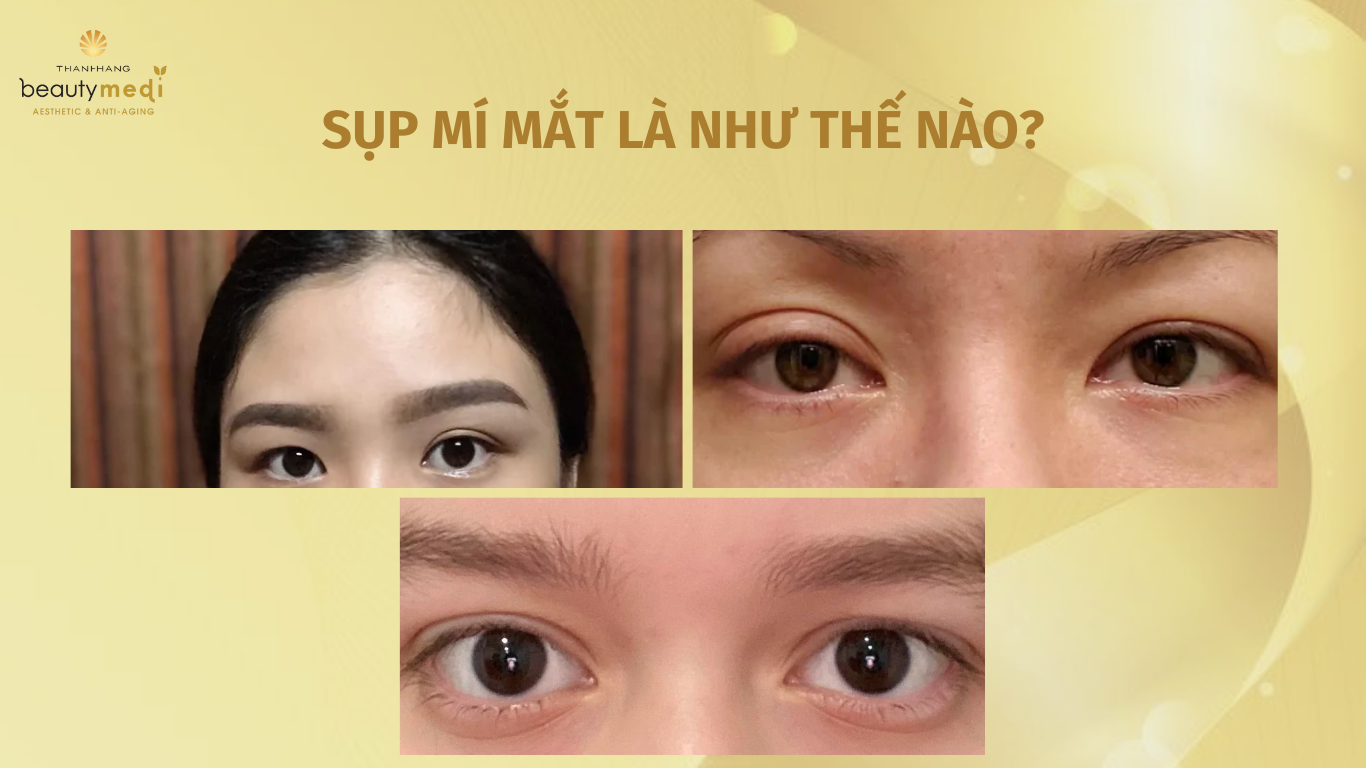 mắt bị sụp mí là như thế nào