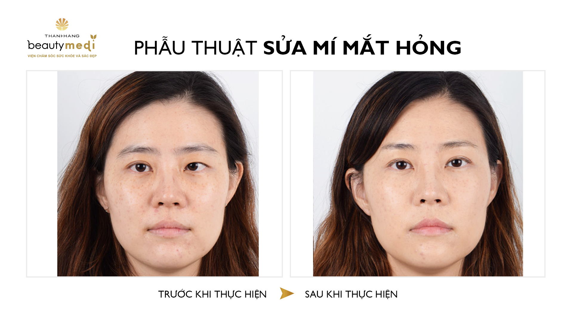 mắt sụp mí trước và sau