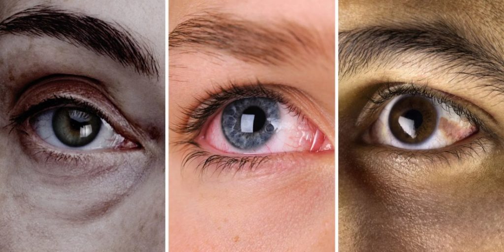 Mắt tam bạch là như thế nào